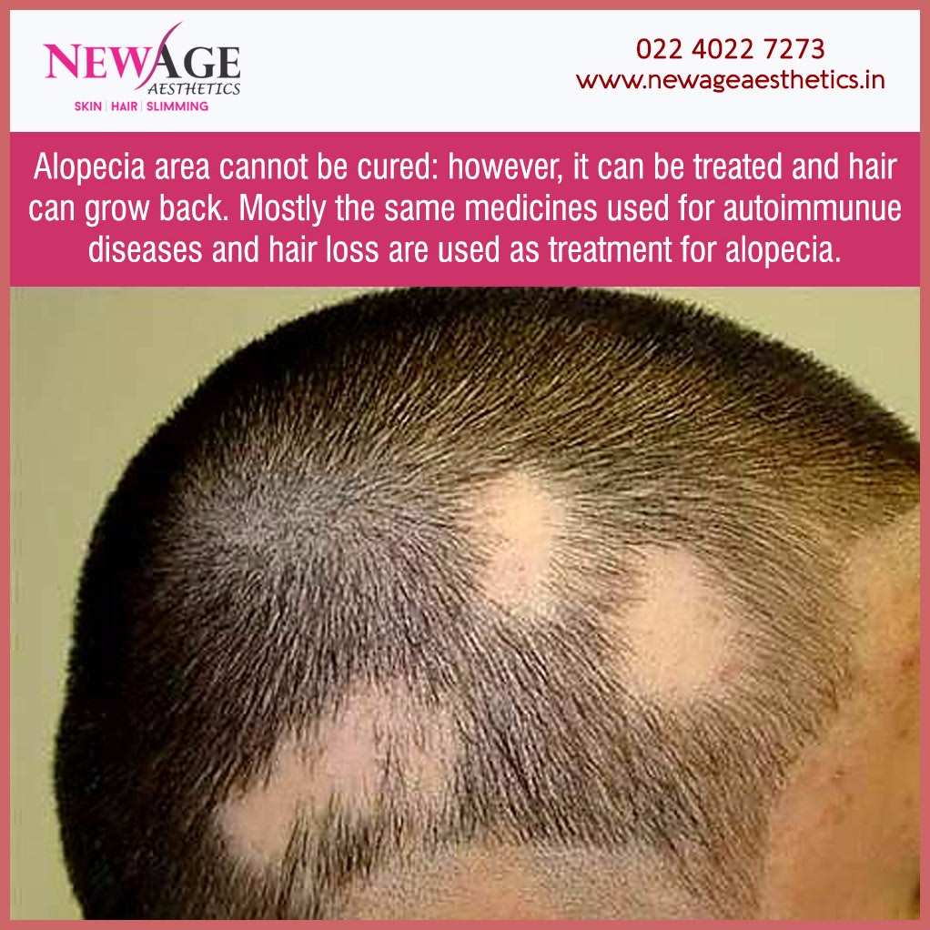 Alopecia areata treatment skin hair homeopathy clinic andheri