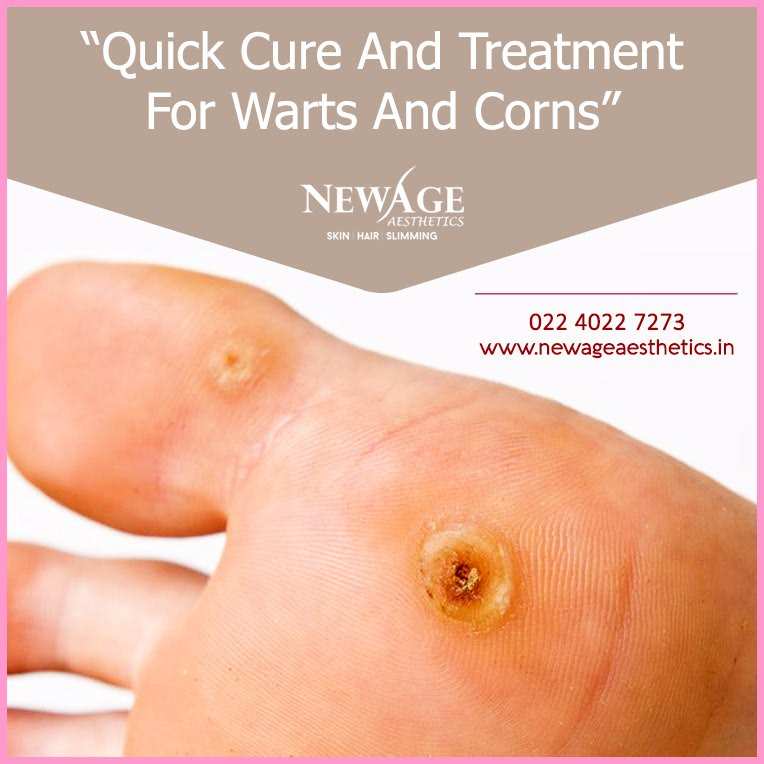 Warts and corns