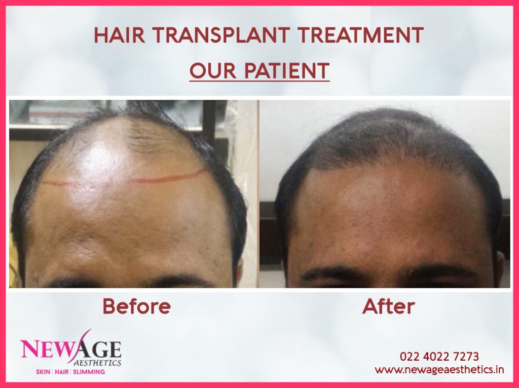 Hair transplantation before and after