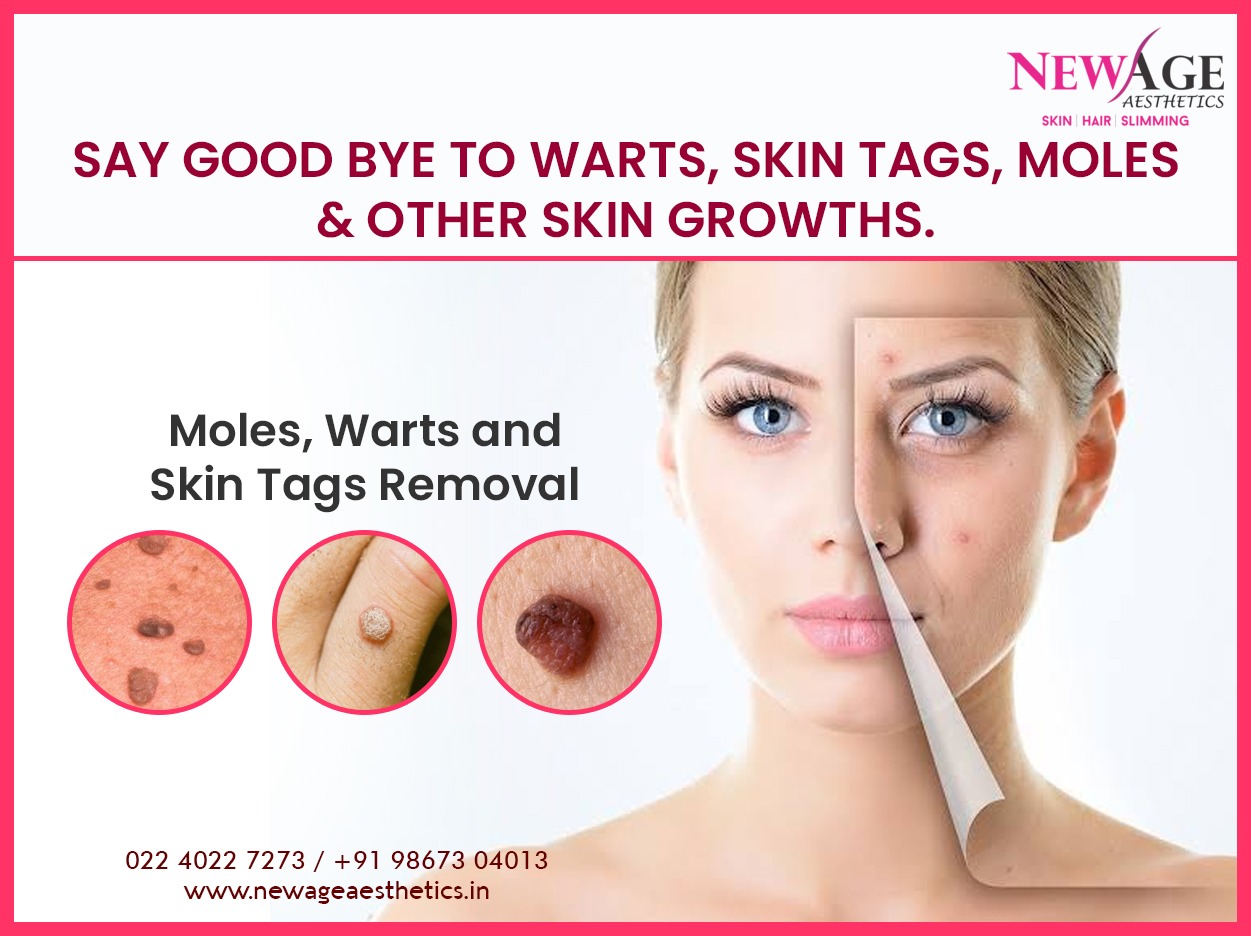 freckles, warts, moles, skin tag removal